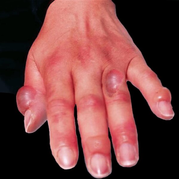 Omrzliny druhého stupně: puchýře s čirým obsahem a snížená citlivost v postižené oblasti. Foto: https://commons.wikimedia.org/wiki/File:Hand_frostbite.jpg